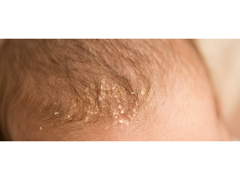 Молочные корочки на голове у ребенка, что это и как их убрать